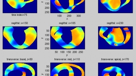 Simulation of ventricular fibrillation, a dangerous cardiac rhythm disorder, in a 3-D model of the canine ventricular anatomy.