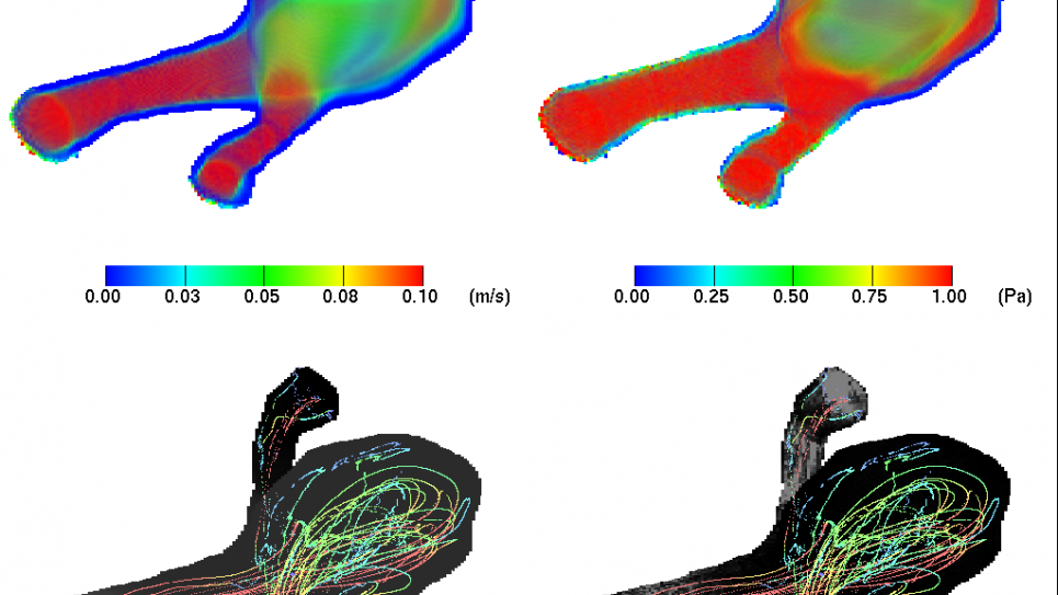 A snapshot of blood flow simulated and visualized within a digitally reconstructed patient-specific middle cerebral artery aneurysm.